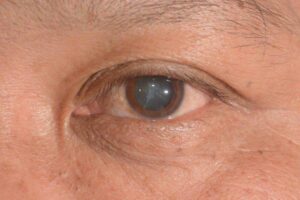 What Is A Cataract?