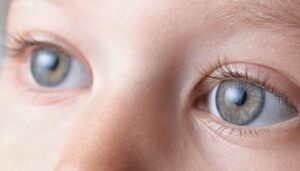 cataract in children