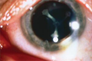 What Is Presenile Cataract?