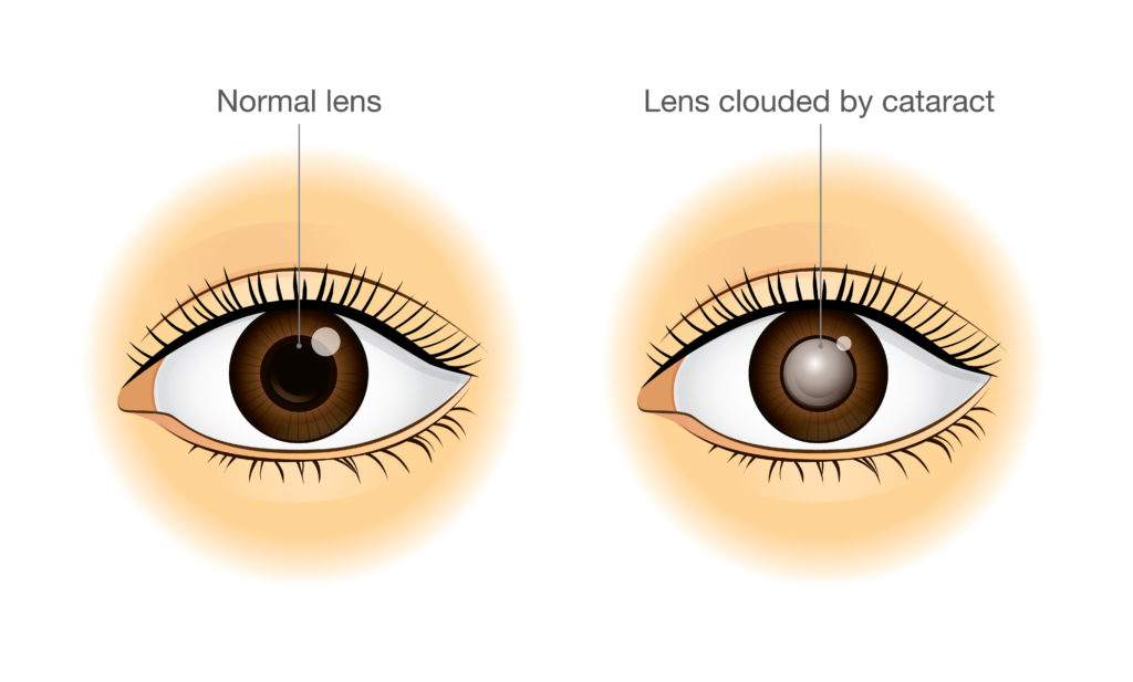 Central Cataract: Causes, Symptoms, and Treatment Options