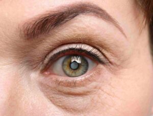 What Is A Cataract?
