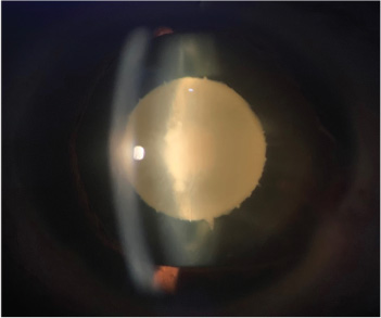How to Detect and Treat a Lamellar Cataract