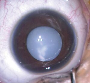 Metabolic Cataract: What It Is and How You Can Treat It