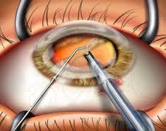 Cataract Cost in Ahmedabad