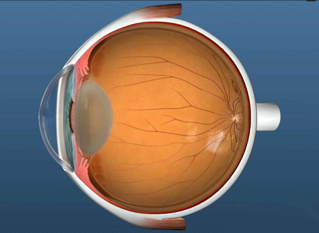 What Is a Capsular Cataract and How Can You Prevent It?