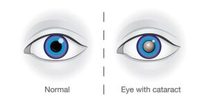 How Right Eye cataract Is Treated?