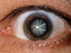 How Does It Different From Other Cataract Types?