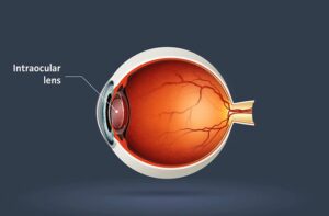 What Are Johnson and Johnson's Intraocular Lenses