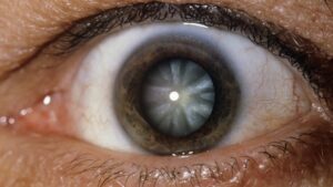 What is a Riders Cataract
