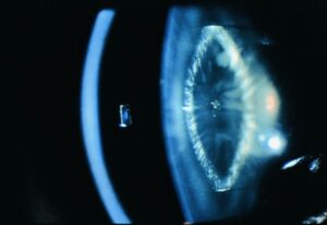 What Is Lamellar Cataract?