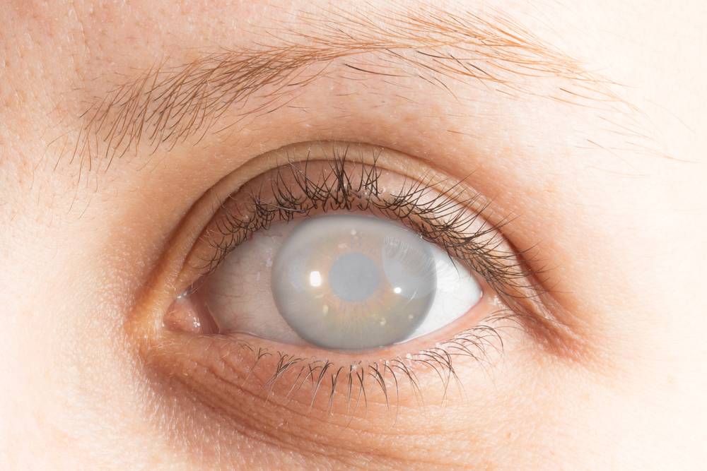 A Comprehensive Guide to Congenital Cataract Treatment
