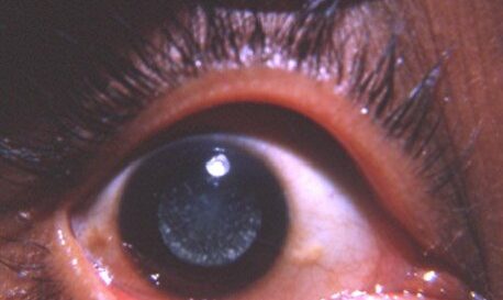 Coronary Cataract: Meaning, Causes, Diagnosis And Treatment
