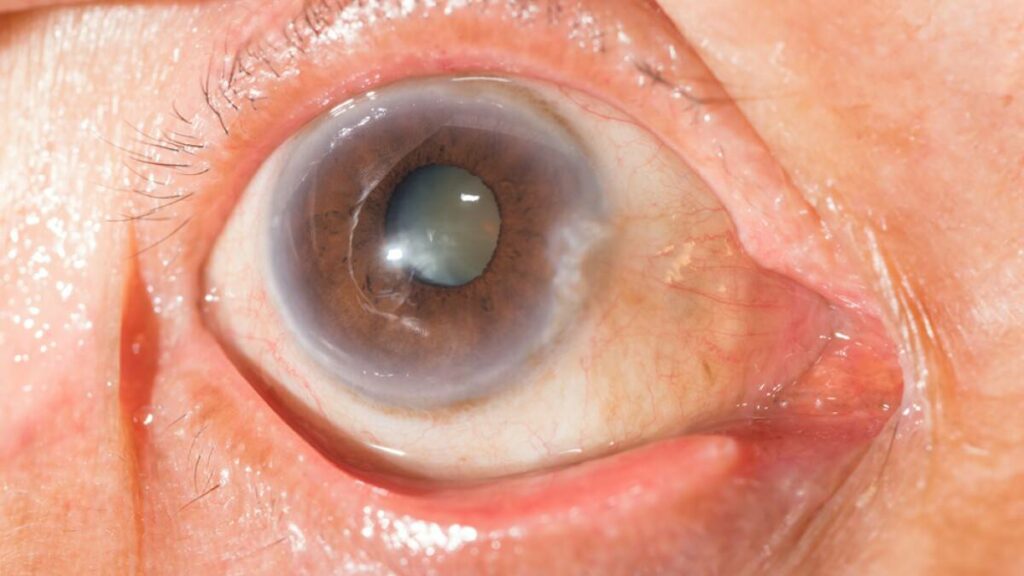 What is an Incipient Cataract? Things You Should Know