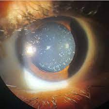 What Is A Punctate Cataract?