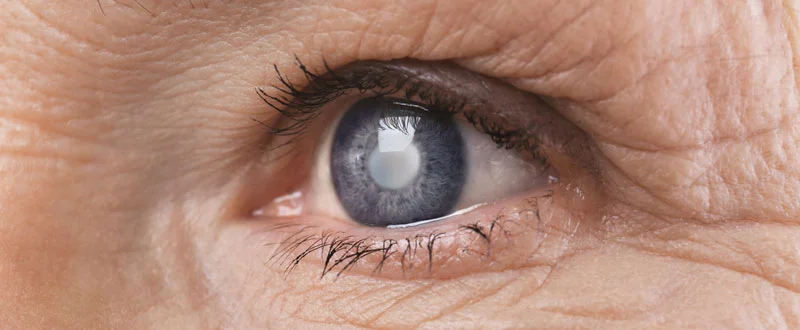 Diabetic Cataract: Causes, Symptoms, and Treatment