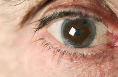 Is Diabetic Cataract Curable?
