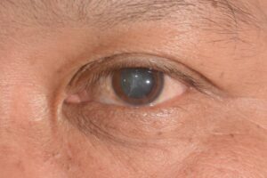 What Is A Diabetic Cataract?