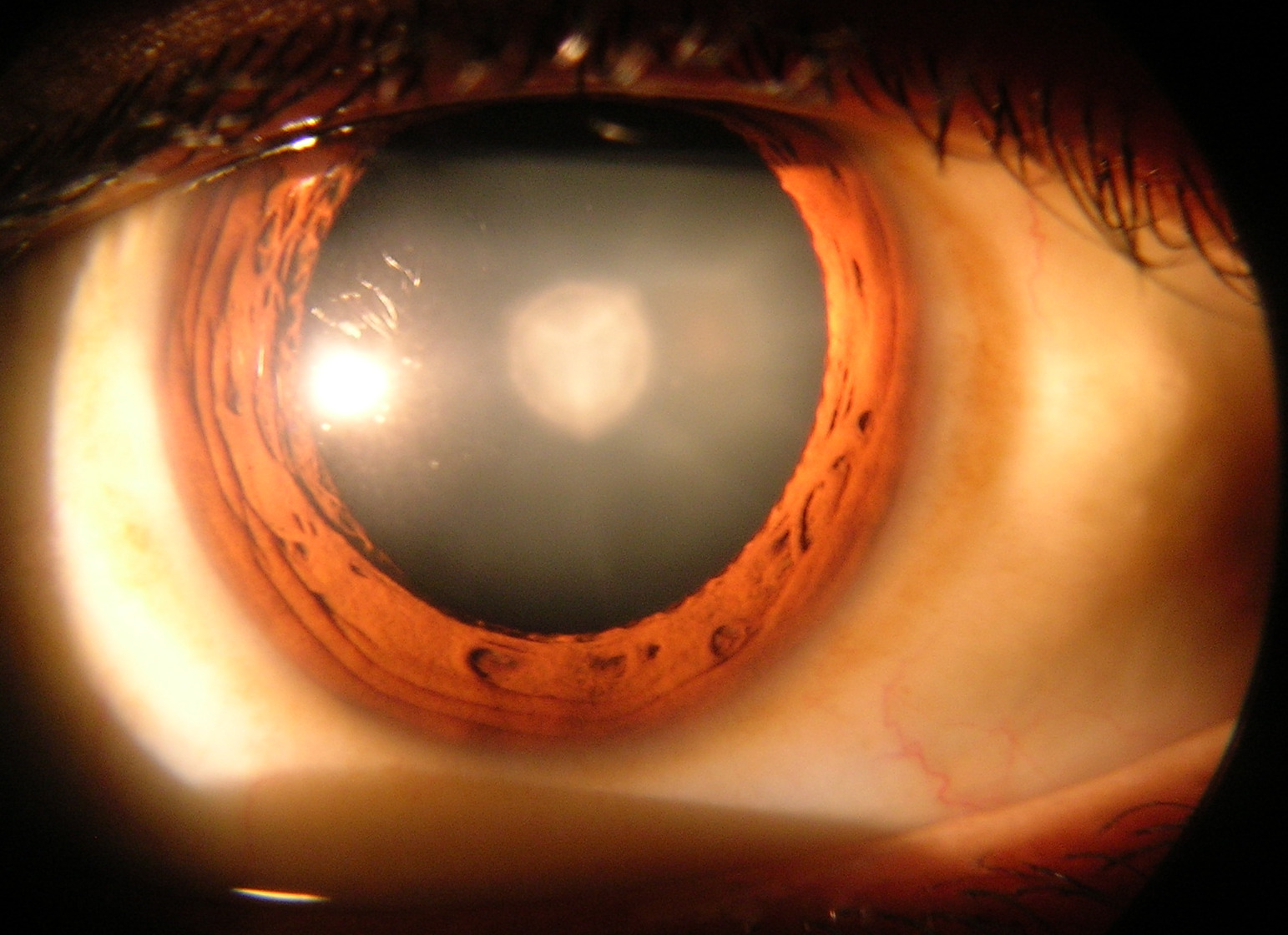 Causes of Intumescent Cataracts