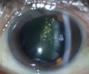 Christmas Tree Cataract: Detailed Guide on This Cataract