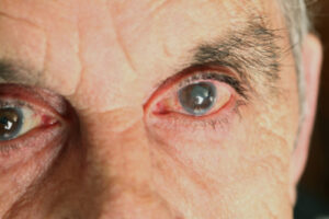 Congenital Cataracts