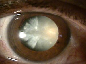 Dense Cataract: Guide On This Type of Cataract