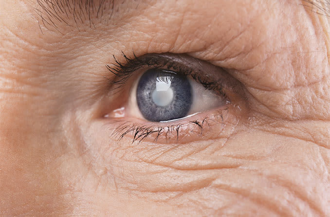 Different Types of Cataracts