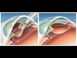 How is a Stellate Cataract Treated?