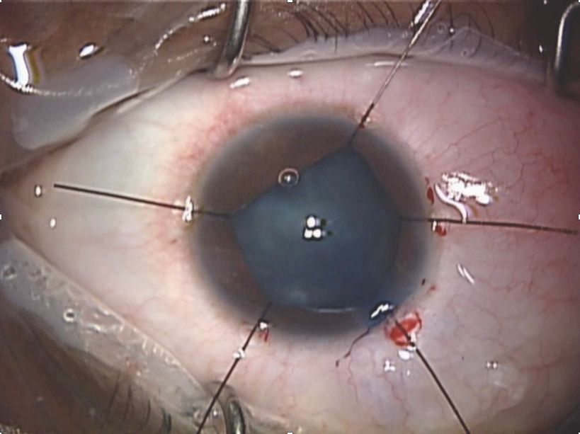 IRIS Hooks Cataract Surgery : Procedure and Benefits of It