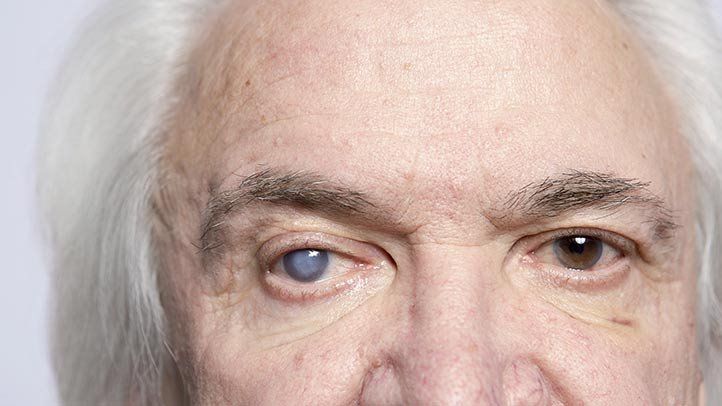 Intumescent Cataract: Signs, Causes, Treatment Options