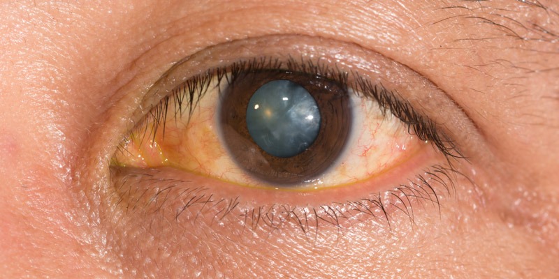 Nuclear Sclerotic Cataract: Signs, Causes, Treatment Options