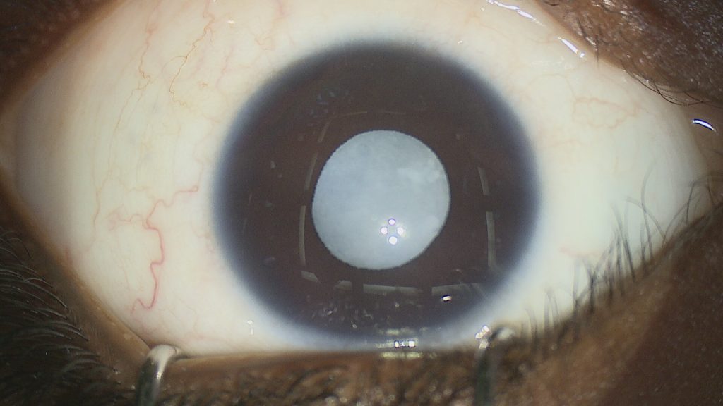 Signs of Congenital Cataract