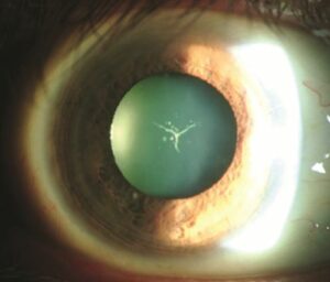 Signs of  Spear-Shaped Cataracts