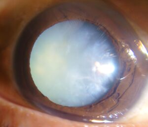 Snowstorm Cataract: Detailed Guide on This Cataract