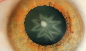 Spear-Shaped Cataract: All About This Type of Cataract