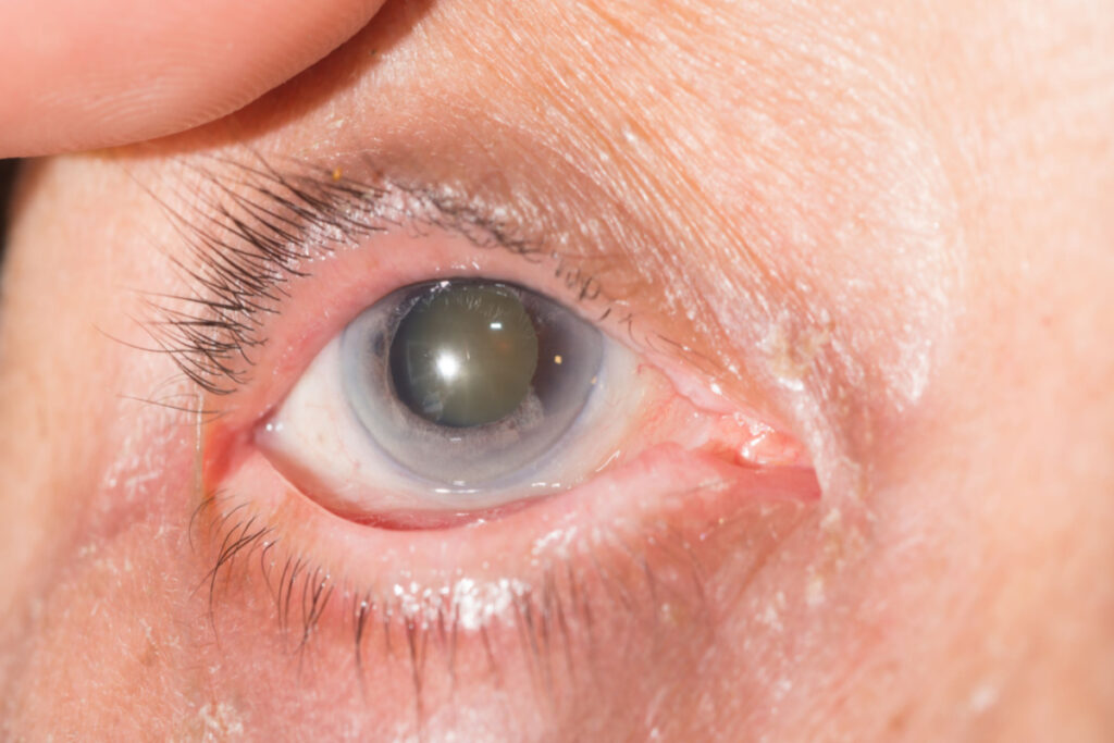 Symptoms of Sclerotic Cataract