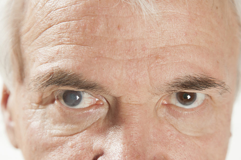 Types of Cataracts: Detailed Guide On Types of Cataracts