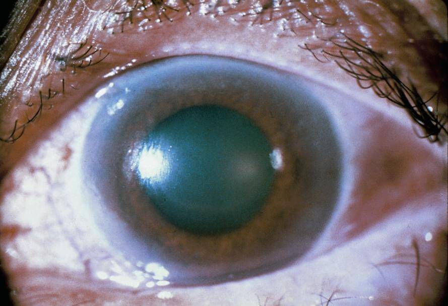What Are The Symptoms Of a Stellate Cataract?