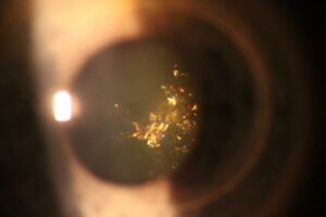 What is Christmas Tree Cataract?