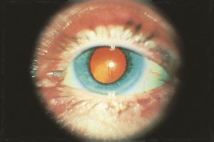 What is Sutural Cataract?