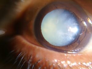 What is a Dense Cataract?