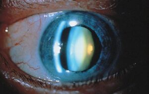 What is a Sclerotic Cataract?