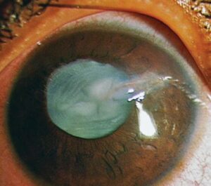 What is a Stellate Cataract?