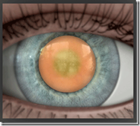 What is an Intumescent Cataract?